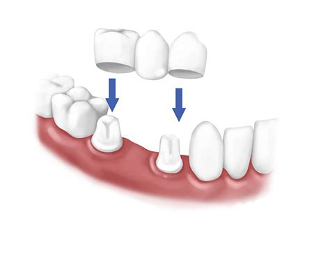 fixed teeth replacement