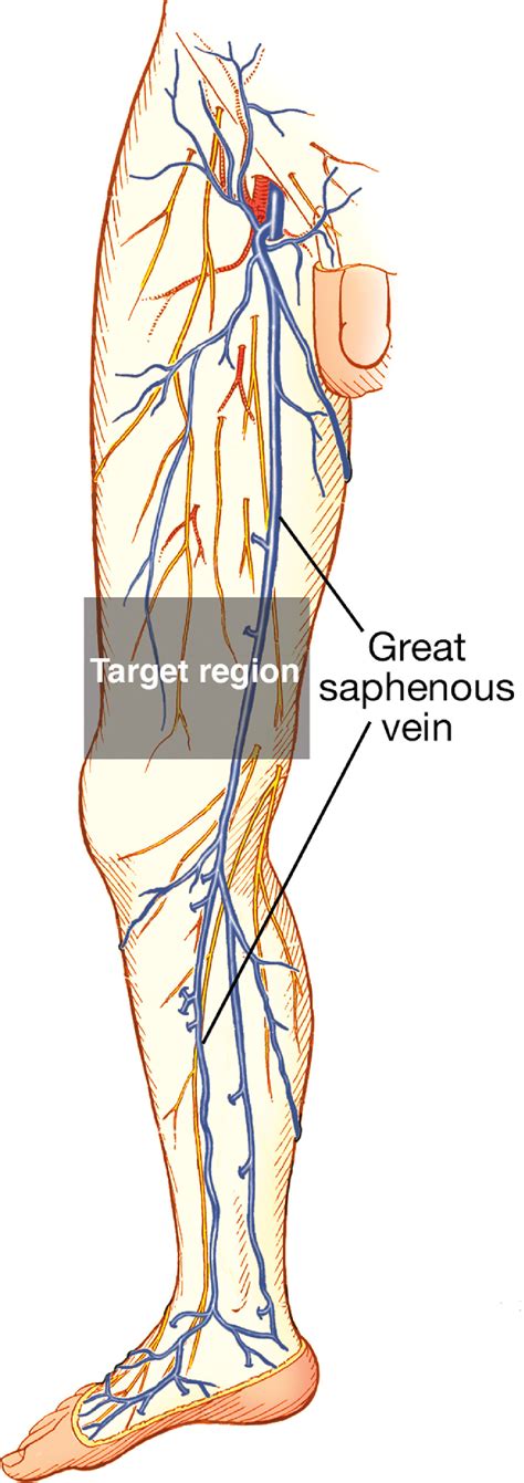 Ultrasound Guided Great Saphenous Vein Access Revisiting An Old Friend