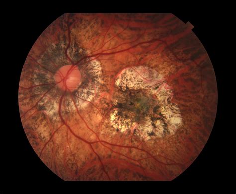 Choroidal Neovascular Membrane Diagram