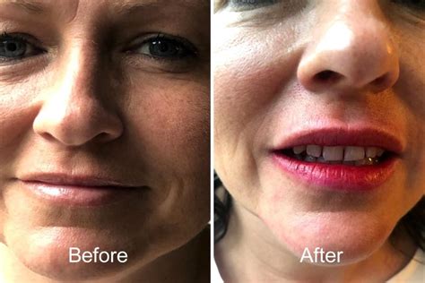 Album Semi Permanent Lip Natural Enhanced Beauty Clinic Leeds