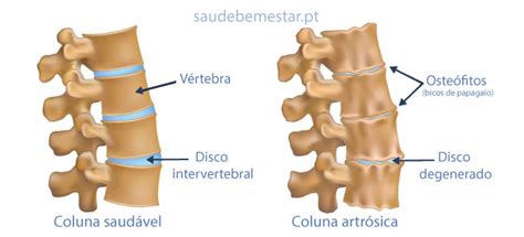 Artrose na coluna o que é tipos sintomas e tratamento Conheça todas