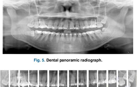 Figure 5 From Tooth Numbering And Condition Recognition On Dental Panoramic Radiograph Images