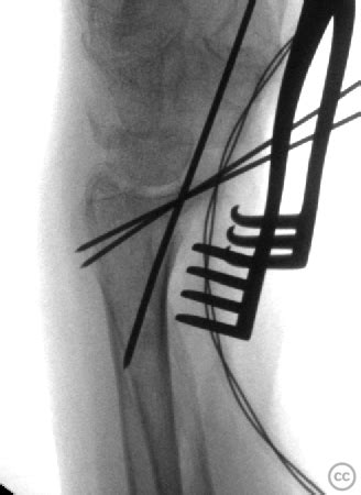 Volar Barton S Volar Rim Fracture Distal Radius