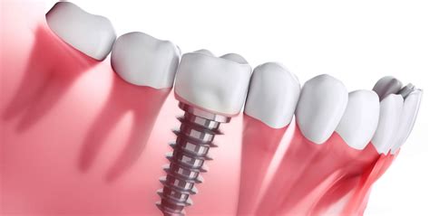 Dental Implants In Katy Tx Cinco Ranch Smiles And Braces