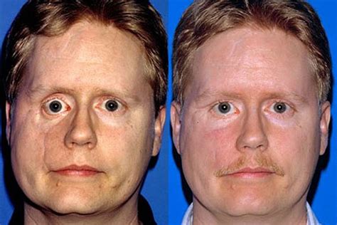 Post-Traumatic Facial Deformities