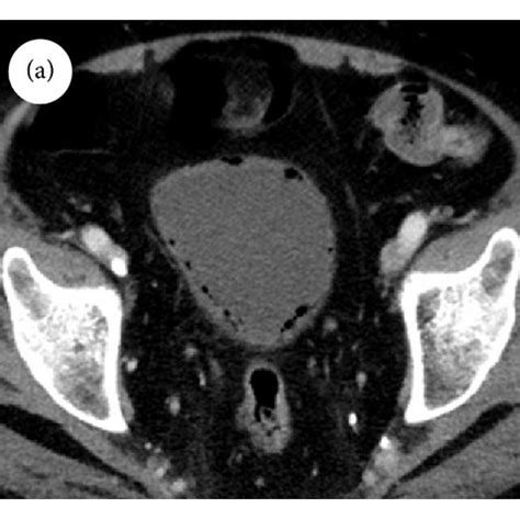 A Computed Tomography Of The Abdomen Showed Multiple Diffuse Gas