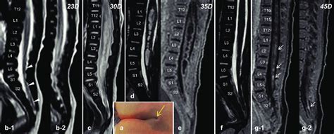 A Photograph Showing A Dimple At The Lumbosacral Region Continuous