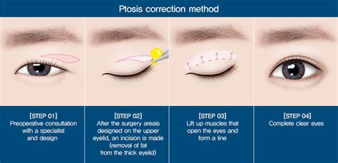 Ptosis Correction Surgery｜braun Plastic Surgery