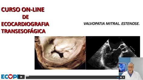 Valvopatia Mitral Estenose Valvar Mitral YouTube