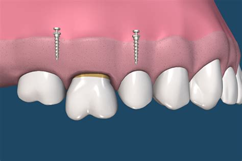 Orthodontic Implants