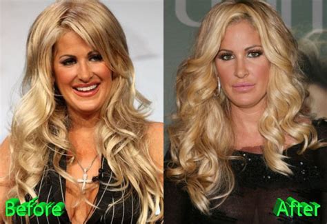 Kim Zolciak Plastic Surgery: All Nips And Tucks For The TV Star