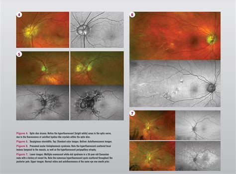 Imaging Helps To Identify Retinal Disease Optometry Times