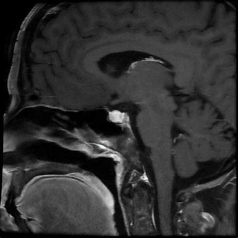 Pituitary MRI revealed an enlarged pituitary measuring 1.4 x 0.7 x 1.1 ...