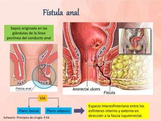 Abscesos Fistulas Anales Y Quiste Pilonidal PPT