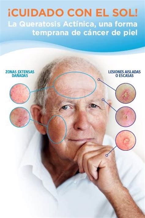 La Queratosis Act Nica Afecta A Un De Los Espa Oles A Partir De