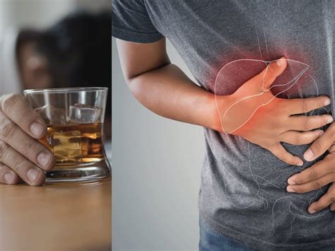 Alcohol-related liver disease: Symptoms, treatment and tips to stop ...