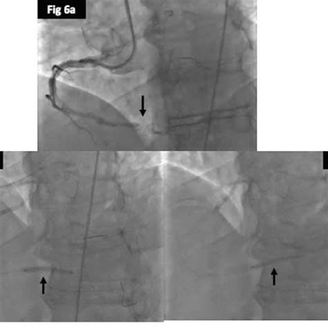 8a: Coronary angiogram showing occluded proximal RCA stent with ...