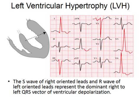 ECG In Left Ventricular Hypertrophy (LVH): Criteria And, 55% OFF