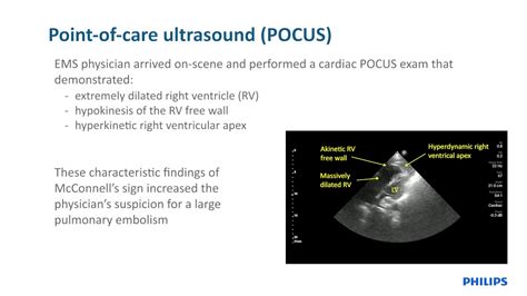 Pre Hospital Point Of Care Cardiac Ultrasound Pulmonary Embolism Youtube