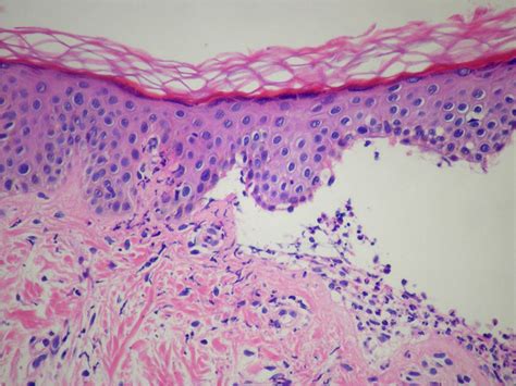 Dermatosis Ampollar Iga Lineal Serie De Casos Actas Dermo