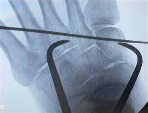 Outcomes Of Lisfranc Injuries Treated With A New Flexible Fixation Technique A Retrospective