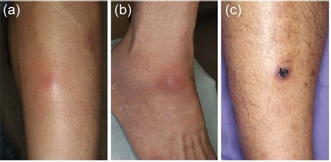 Frontiers Mucocutaneous manifestations of Behçets disease