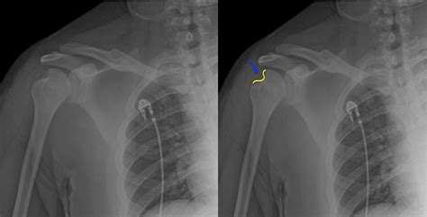 Hill Sachs Deformity Published In Orthopedic Reviews