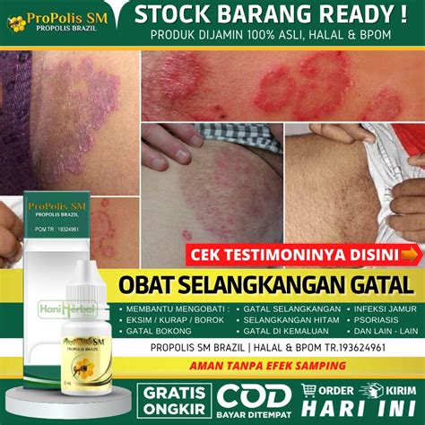 Jual Obat Untuk Selangkangan Gatal Dan Hitam Obat Gatal Akibat Infeksi