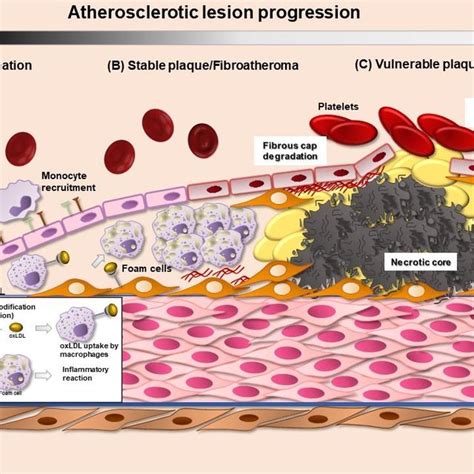 Atherosclerotic Plaque Formation A Lipoprotein Retention To The