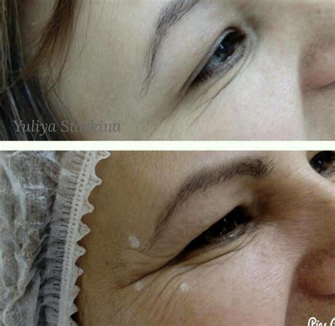 Botox Crow’s Feet Injection Technique Before And After » Facelift: Info, Prices, Photos, Reviews ...