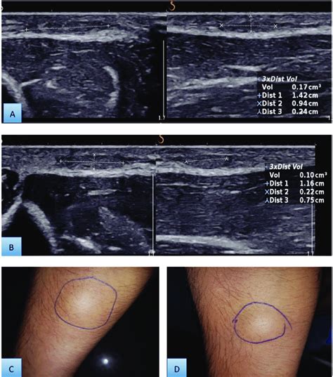 Lipoma Ultrasound Treatment - Infoupdate.org