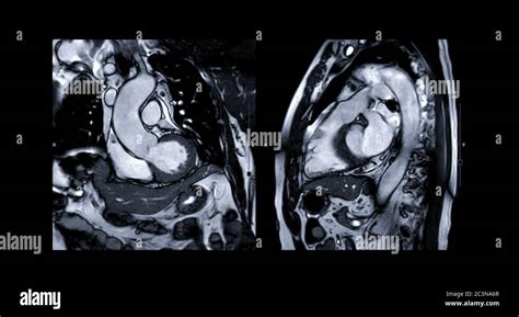 Mri Heart Or Cardiac Mri Magnetic Resonance Imaging Of Heart