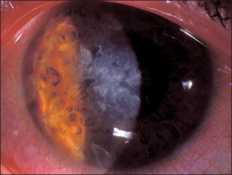 Nocardia Keratitis In A Contact Lens Wearer Cornea Jama Ophthalmology The Jama Network