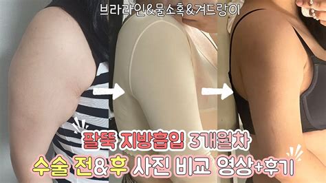 팔뚝 지방흡입 비교 영상💪🏻🔥 브라라인물소혹겨드랑이 3개월차d 솔직한 후기와 영상 추천까지 Youtube