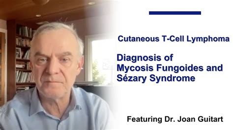 Diagnosis of Mycosis Fungoides and Sézary Syndrome Chapter 2 YouTube