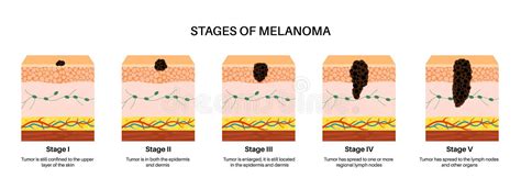 The Stage III Melanoma Tumors Stock Illustration - Illustration of ...