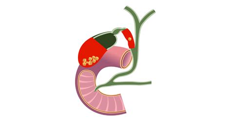 Gallbladder Cancer Types Symptoms Causes Stages And Treatment