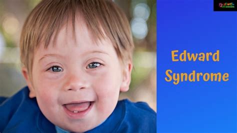 Edward Syndrome Signs And Symptoms Of Edward Syndrome