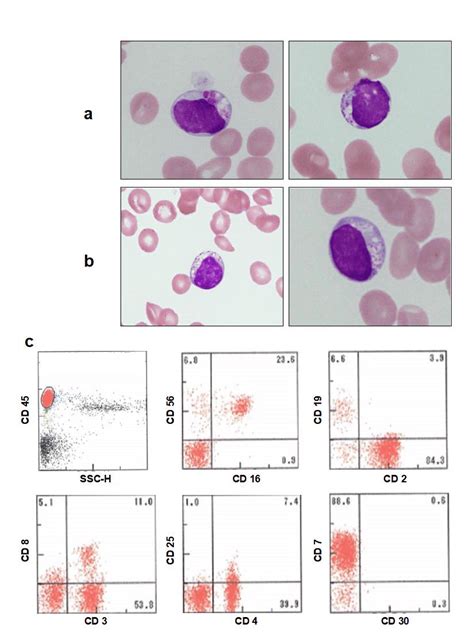 Natural Killer Cell Large Granular Lymphocyte Nk Lgl Lymphocytosis