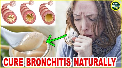 How To Cure Bronchitis Fast Bronchitis Treatment At Home Youtube