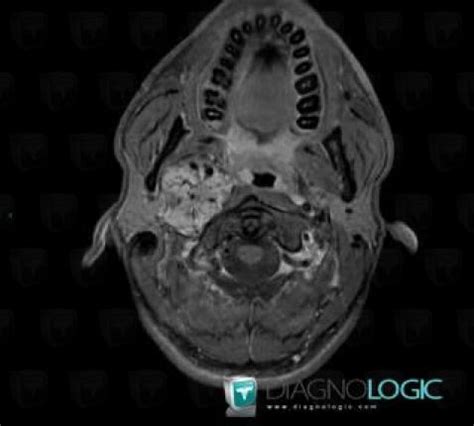 Radiology case : Paraganglioma (CT ,MRI) - Diagnologic