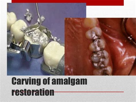 procedure for amalgam restoration