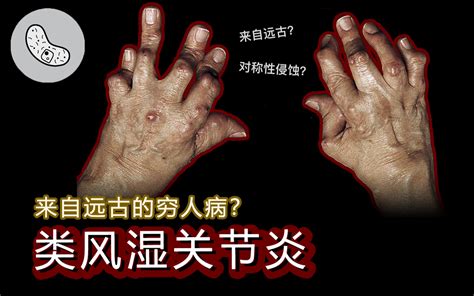 【类风湿关节炎】不死的癌症？来自远古？对称性侵蚀？【灰细胞】 灰细胞 灰细胞 哔哩哔哩视频