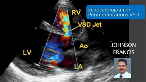 şansă Monumental Scoala elementara perimembranous vsd echo Lung Centimetru prag