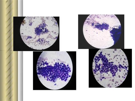 Pdf Citolog A Tiroidea Lesion Folicular Endosuem Org Uy Wp Content