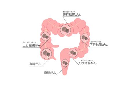 大腸がんは初期症状がない！？原因や治療について医師が解説