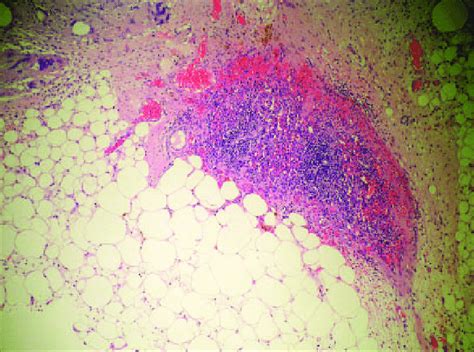 Histopathological examination of the splenic autotransplantation into ...