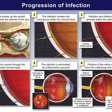 Progression Of Infection Trialexhibits Inc