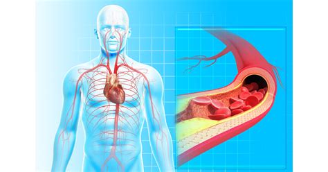 Arteriosclerosis Hardening Of The Arteries