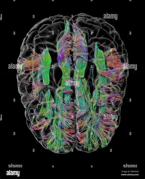 White Matter Fibres Dti Mri Scan Stock Photo Alamy